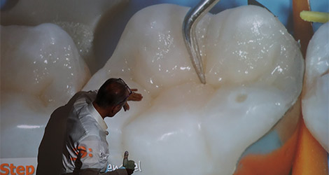 Posterior Bio Esthetic restorations