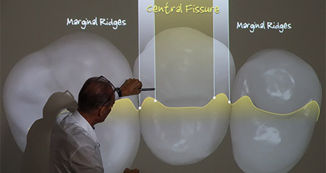 Posterior Bio Esthetic restorations