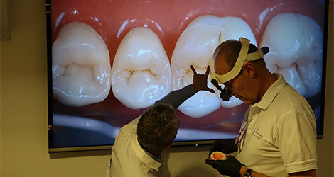 Posterior Bio Esthetic restorations